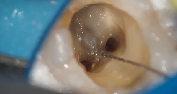 CT・マイクロスコープ使用